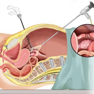 Laparoscopia